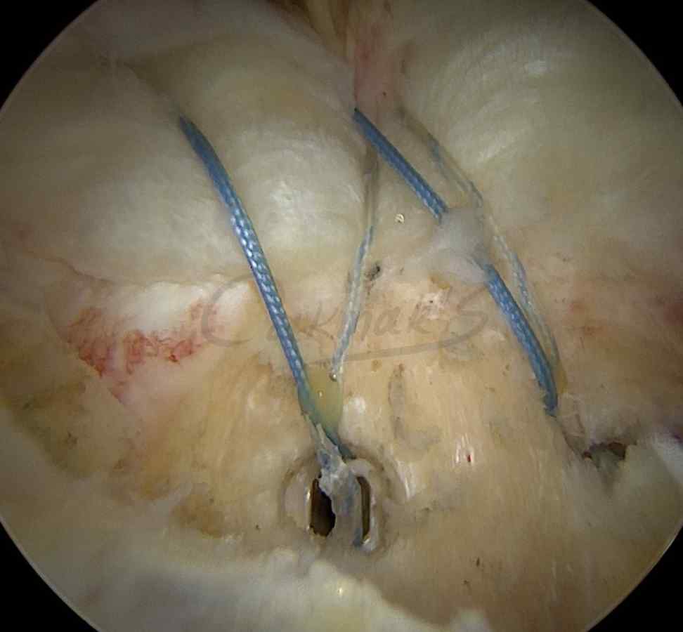 Shoulder muscle tear surgery
