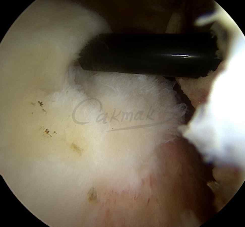 Symptoms of a shoulder muscle tear