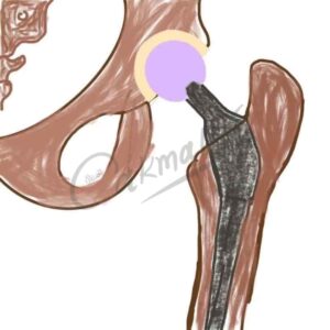 Hip Replacement Surgery