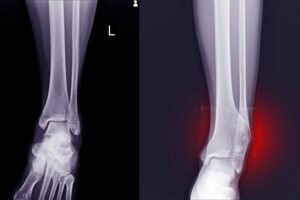 Osteochondroma Surgery