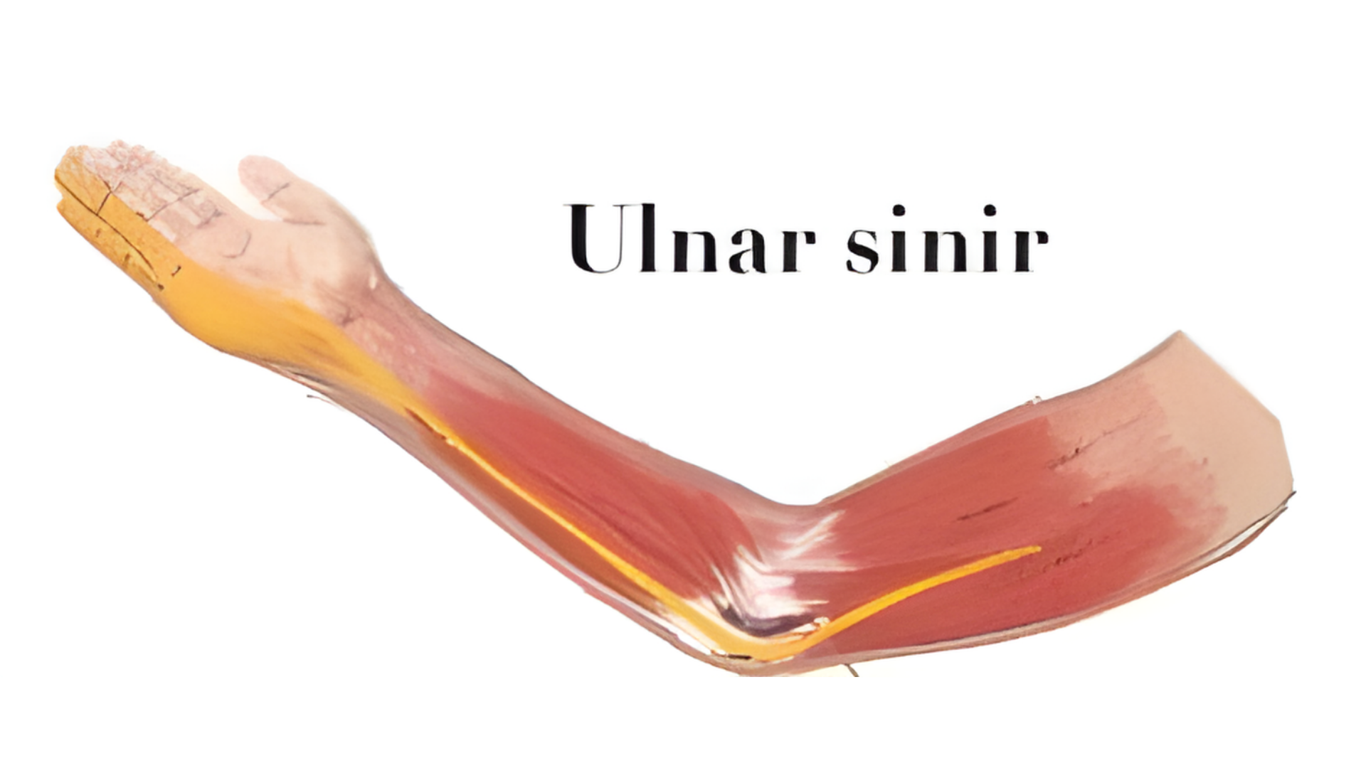 ulnar sinir sıkışması