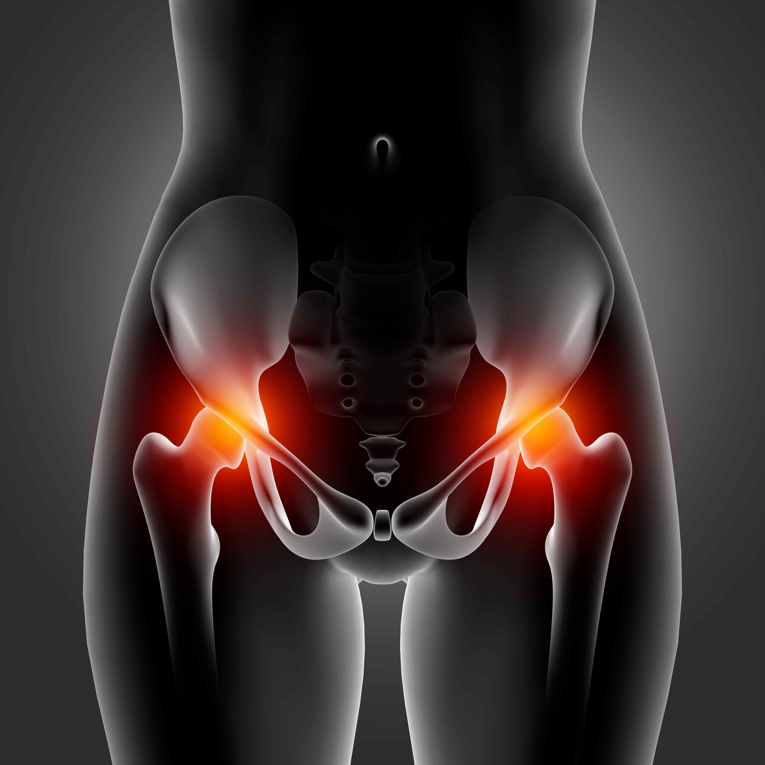 Kalça Labrum Yırtığı Ameliyatı Olanlar